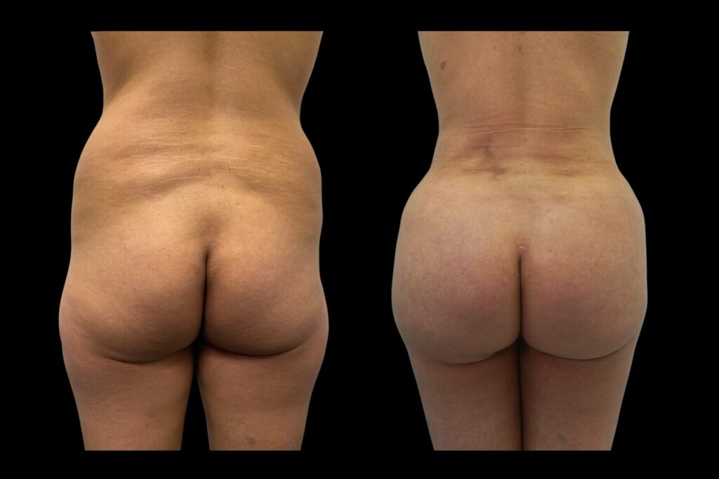 BBL Fat Transfer with Tummy Tuck and Liposuction. Before and after. Back profile.