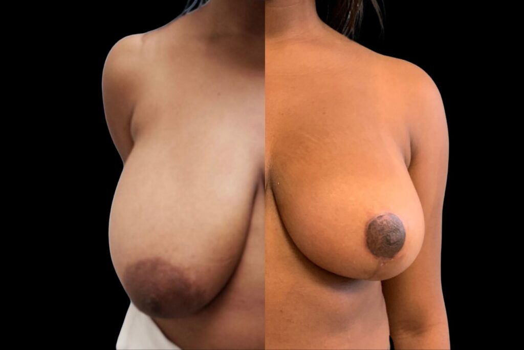 Breast Augmentation with Lift. Before and after. Front profile.