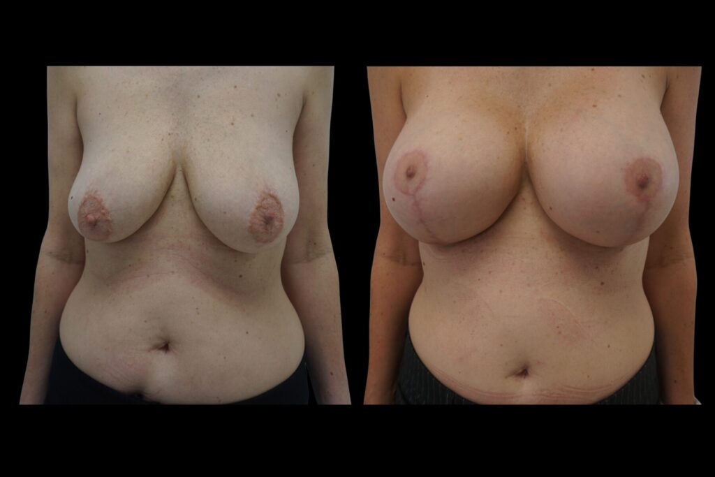 Breast Augmentation with Lift. Before and after. Front profile
