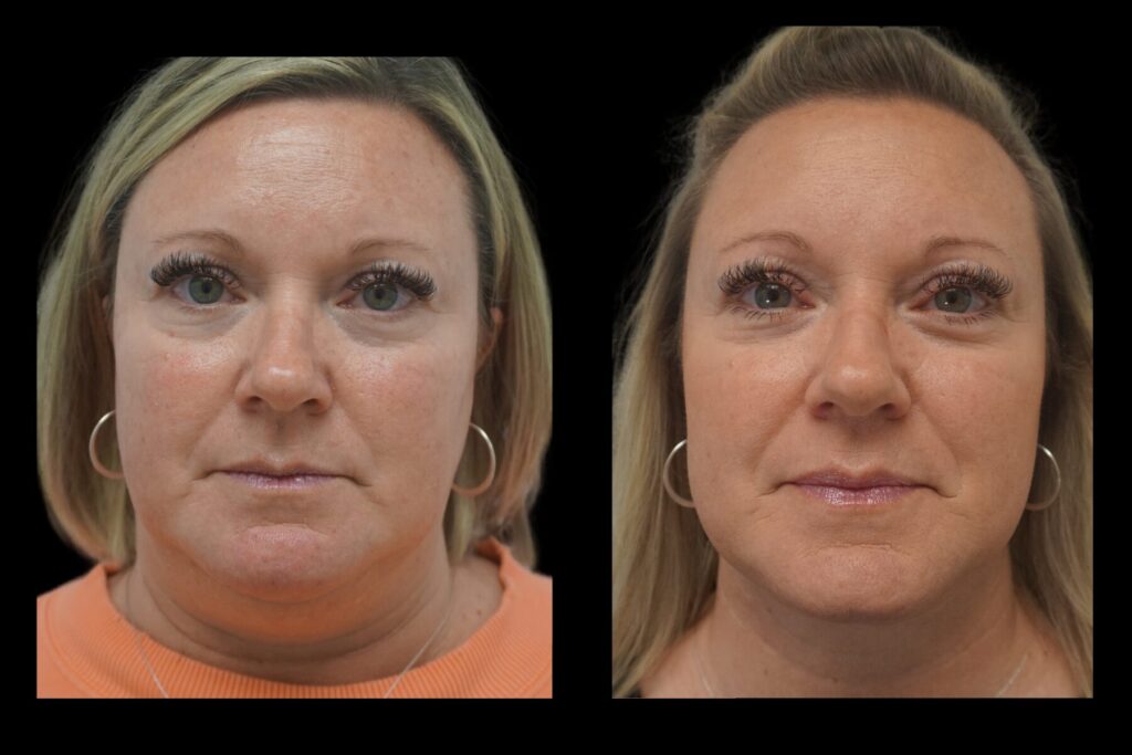 Neck Lipo with Renuvion Jplasma Skin Tightening. Before and after. Front profile.