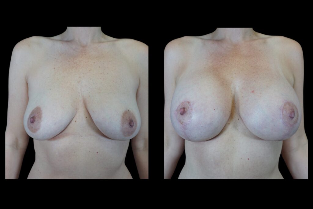 Breast Augmentation. Before and after. Front profile.
