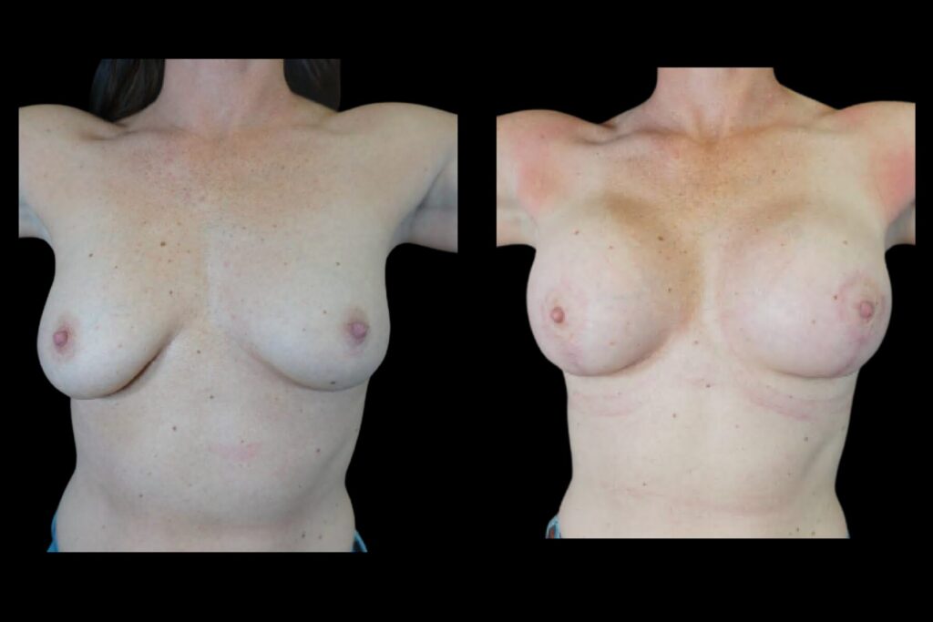 Breast Augmentation. Before and after. Front profile arms up.