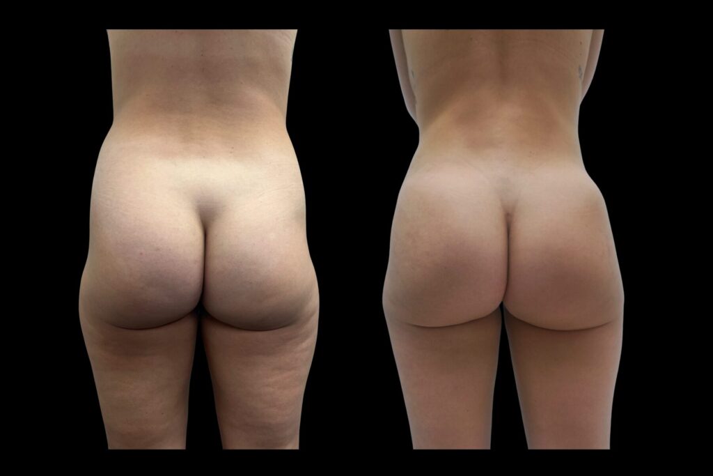 BBL Fat Transfer with Tummy Tuck. Before and after. Back profile.