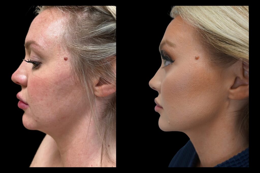 Chin Lipo with Renuvior J Plasma. Before and after. Left profile.