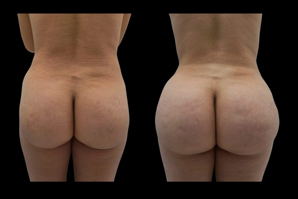BBL Fat Transfer with Lipo 360. Before and after. Back profile.