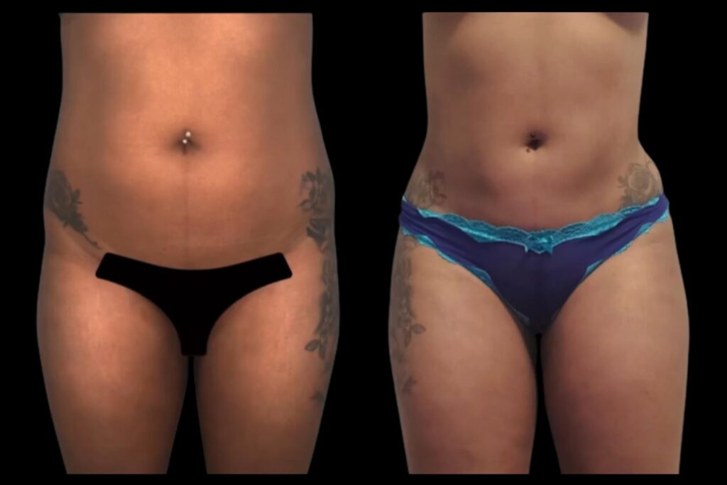 Liposuction. Before and after. Front Profile