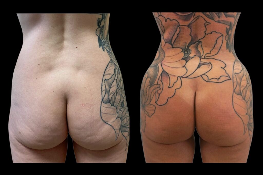 BBL Fat Transfer with Liposuction. Before and after. Back profile.