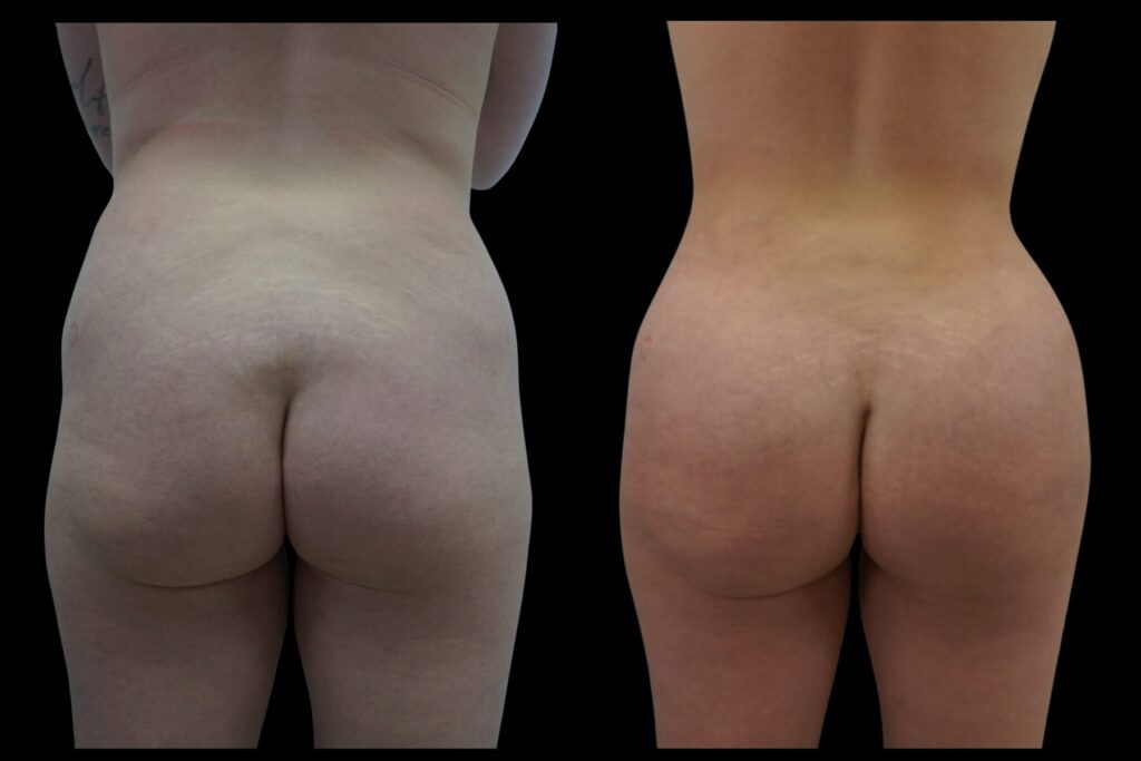 BBL Fat Transfer with Liposuction. Before and after. Back profile.