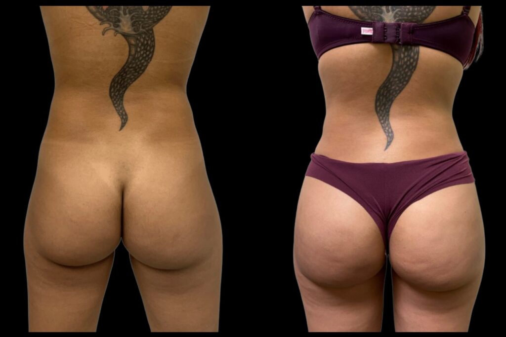 BBL Fat Transfer with Liposuction. Before and after. Back profile.