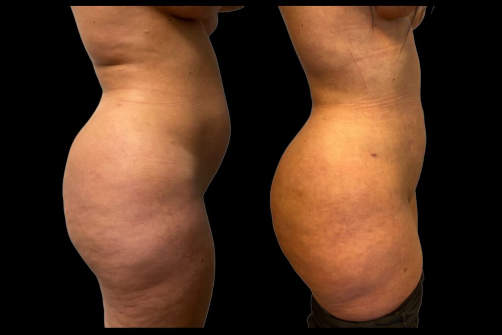 BBL Fat Transfer with Liposuction. Before and after. Right profile.