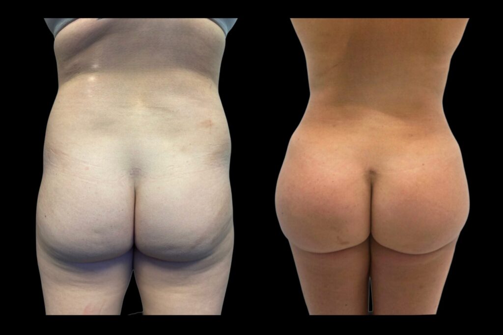 BBL Fat Transfer with Liposuction. Before and after. Back profile.
