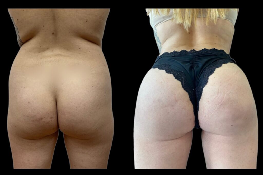 BBL Fat Transfer with Lipo360. Before and after. Back profile.