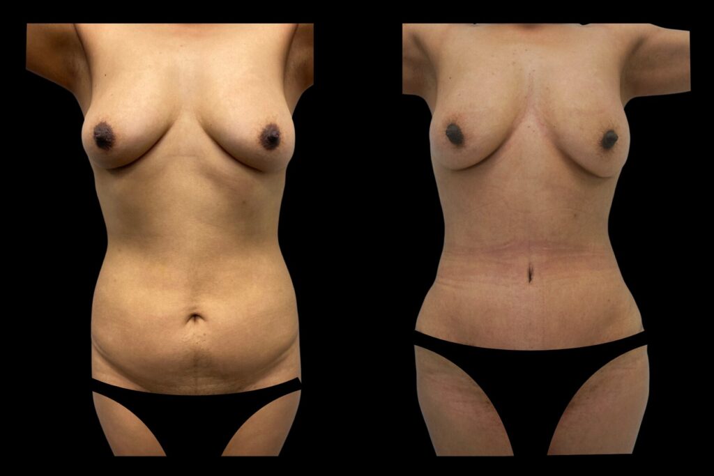 BBL Fat Transfer with Tummy Tuck and Liposuction. Before and after. Front profile.