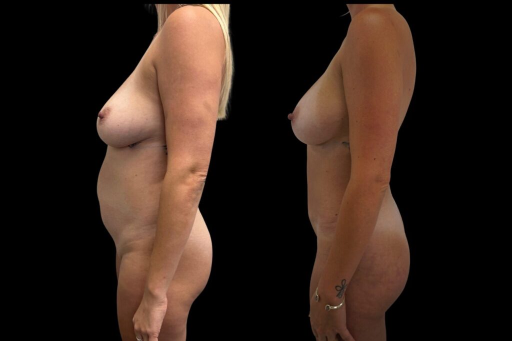Mommy Makeover with Breast Augmentation, Tummy Tuck and Liposuction. Before and after. Left profile.