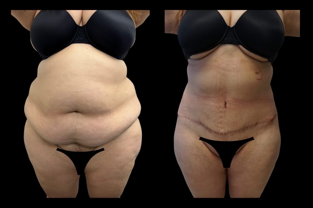 Mommy Makeover with Breast Lift and Tummy Tuck. Before and after. Front profile. Arms raised