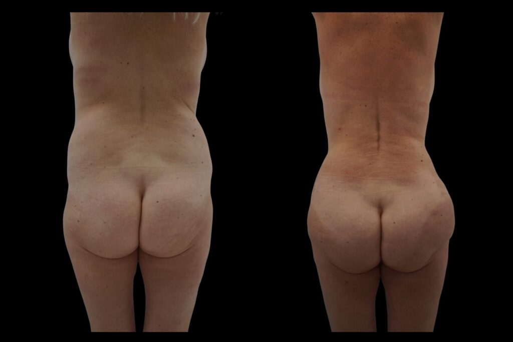 Mommy Makeover with BBL and Breast Lift. Before and after. Back profile.