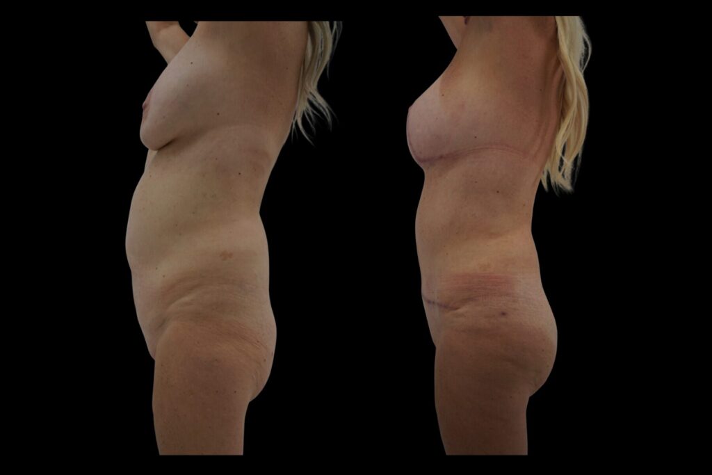 Mommy Makeover with BBL and Breast Lift. Before and after. Left profile.