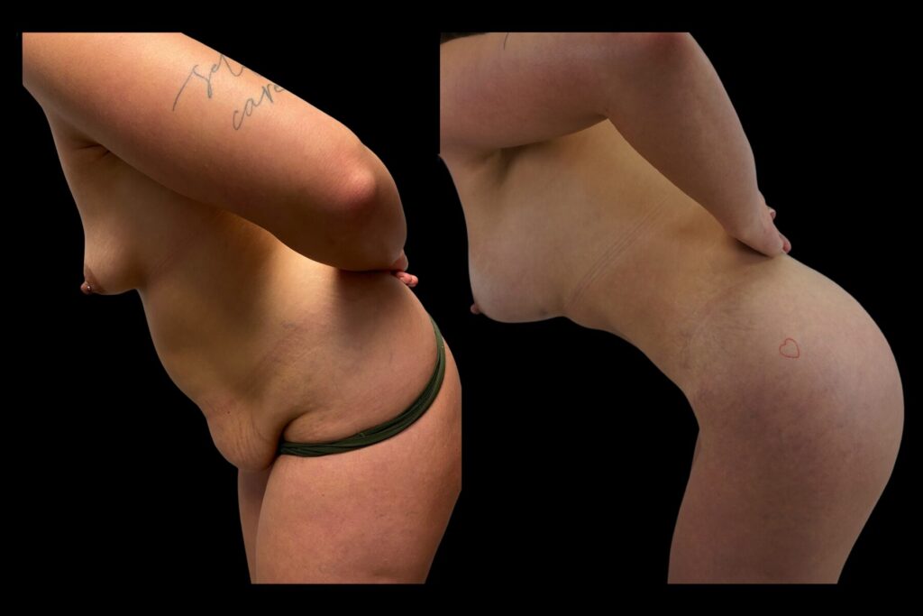 Mommy Makeover with Tummy Tuck. Before and after. Left bent profile.