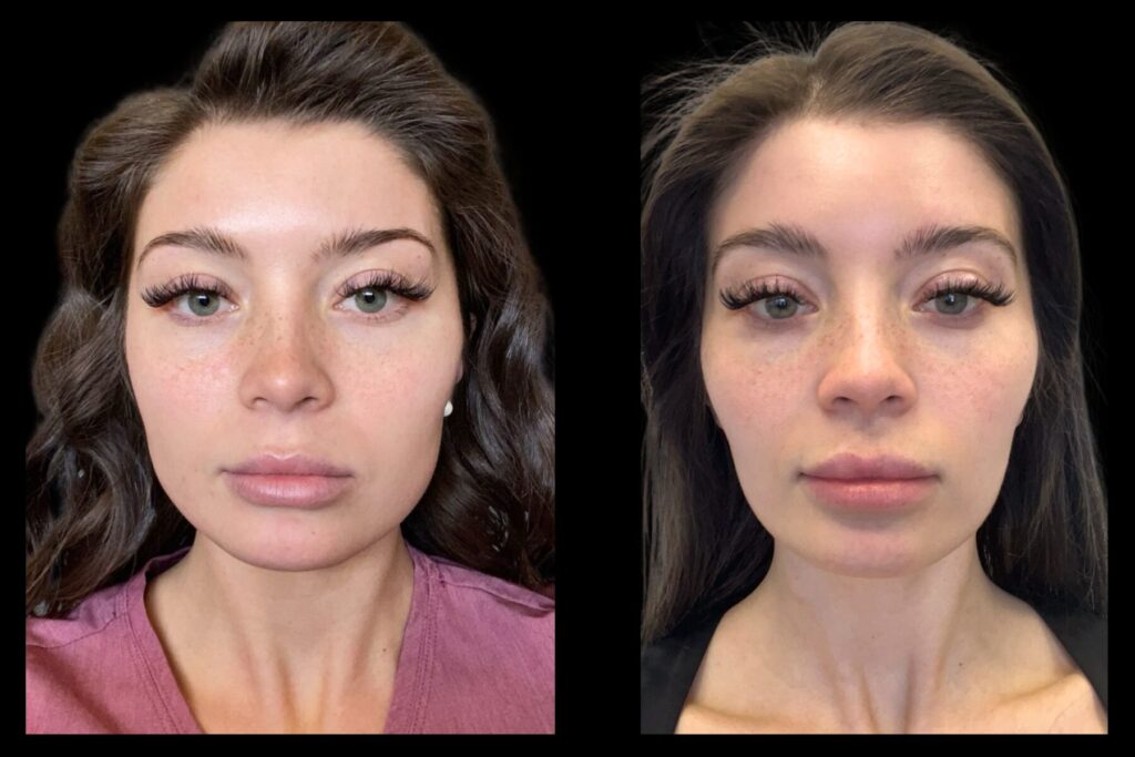 TMJ Treatment. Before and after. Front profile