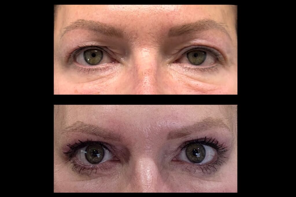 Quad Blepharoplasty. Before and after. Front profile.