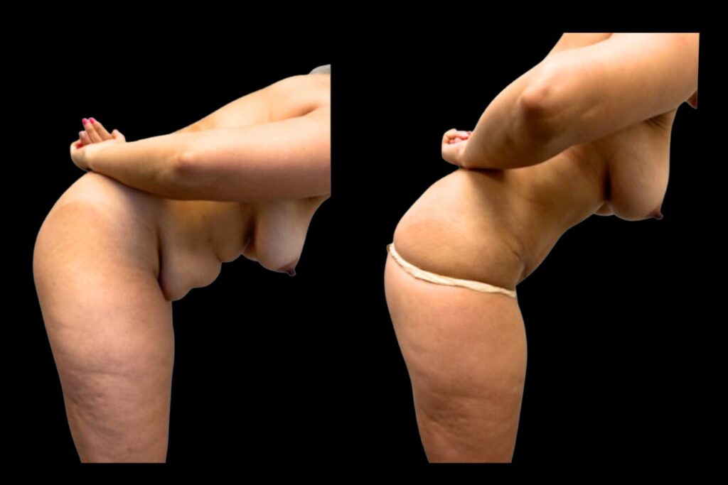 Tummy Tuck. Before and after. Right profile.