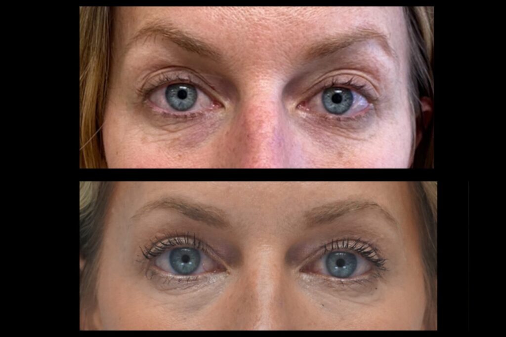Upper Blepharoplasty. Before and after. Front profile