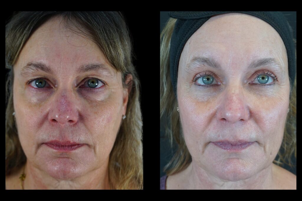 Upper Blepharoplasty. Before and after. Front profile.