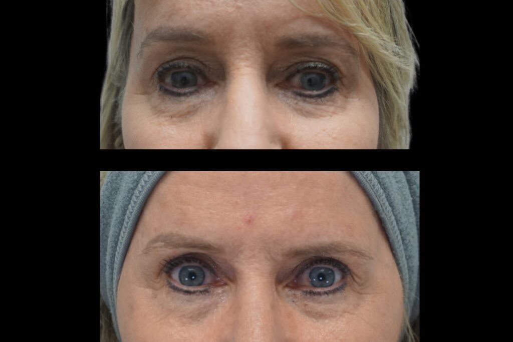 Upper Blepharoplasty. Before and after. Front profile