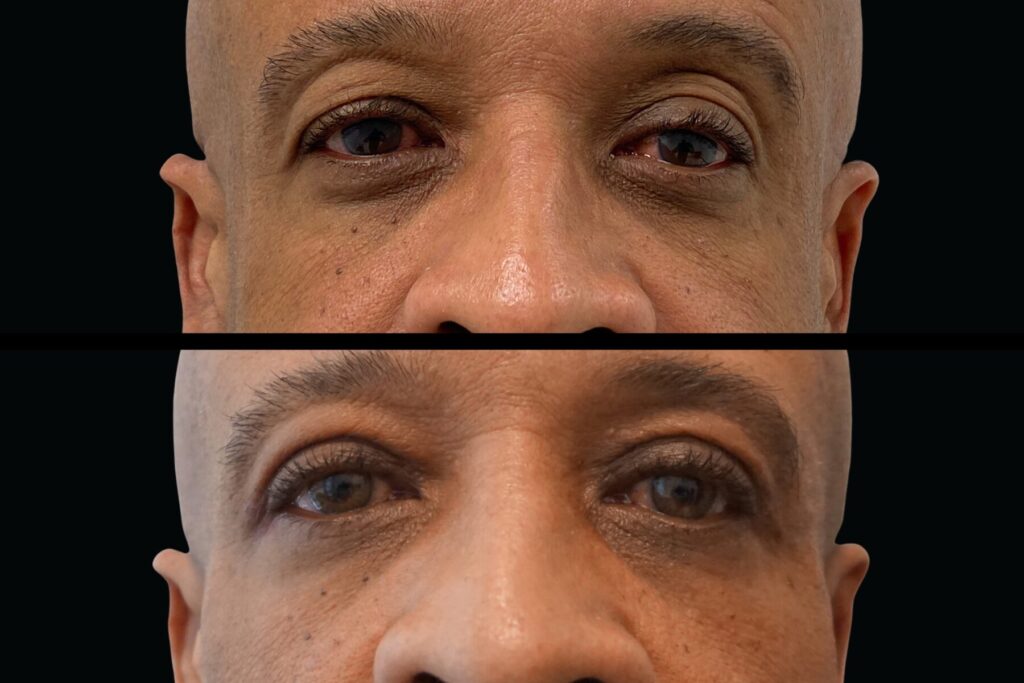 Upper Blepharoplasty. Before and after. Front profile.
