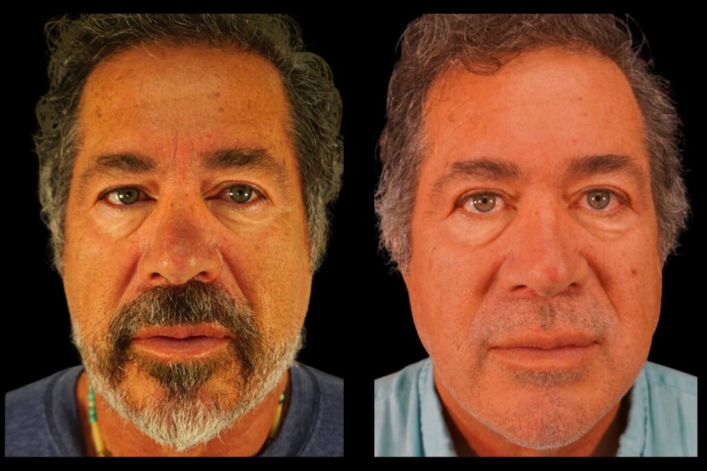 Upper Blepharoplasty. Before and after. 6 months post-op. Front view.
