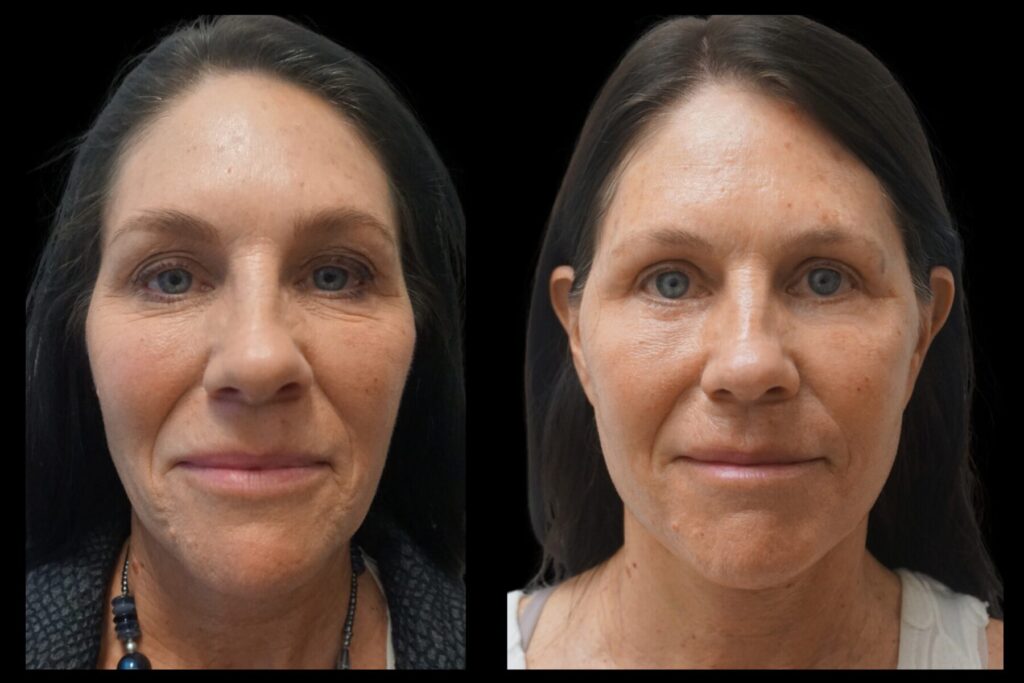 Upper Blepharoplasty. Before and after. Front profile.