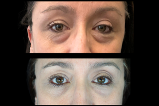Lower Eyelid Lift
