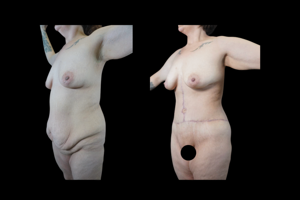 Fleur-de-Lis Tummy Tuck Before and After