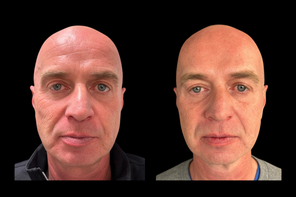 Before and after facial balancing with smoother forehead lines and improved under-eye hollows
