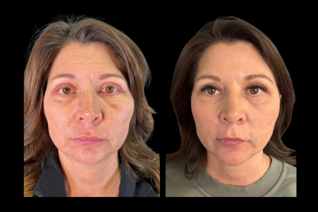 Before and after female facial balancing treatment showing smoother under-eye areas, improved cheek support, and natural facial rejuvenation.