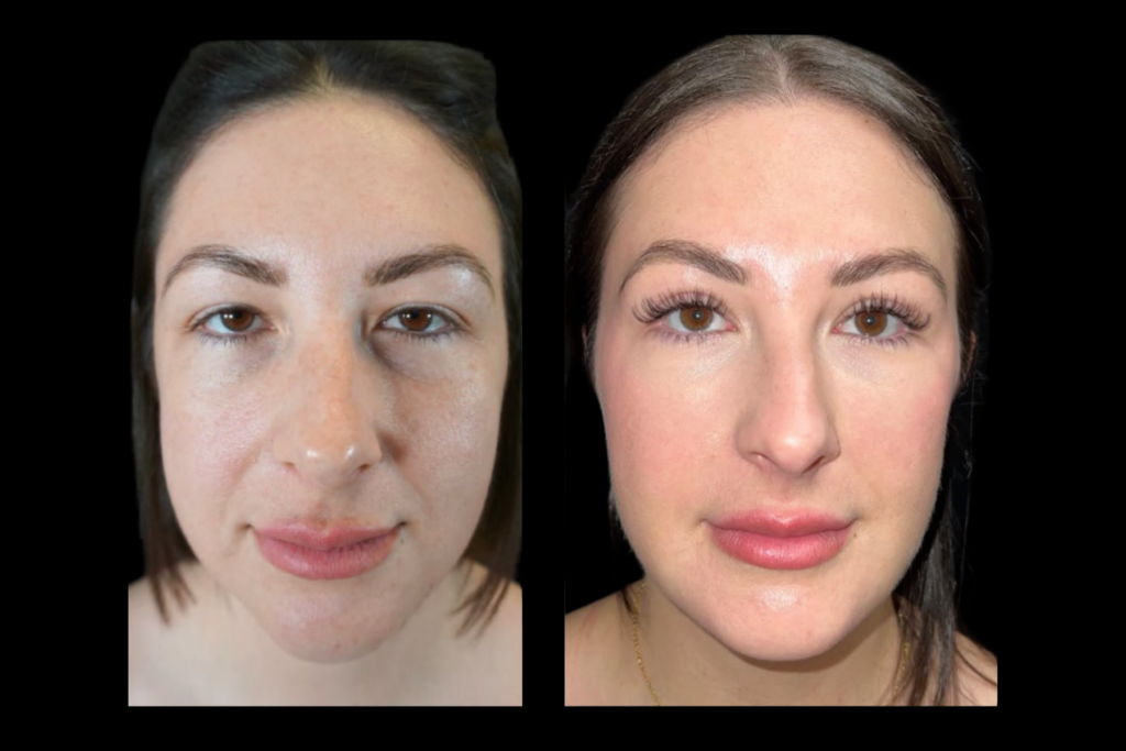 Before and after upper blepharoplasty showing smoother upper eyelids, improved eye openness, and refreshed facial appearance.