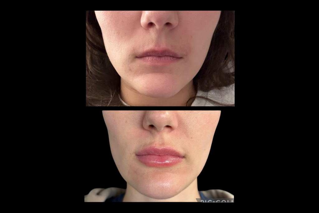 Before and after lip filler treatment showing enhanced lip volume, improved lip definition, and natural-looking lip augmentation results.