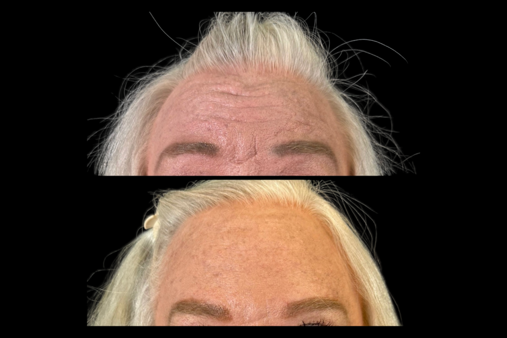 Before and after forehead wrinkle treatment showing smoother forehead skin, reduced frown lines, and softer dynamic facial wrinkles.