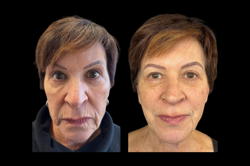 Before and after facial balancing treatment showing smoother under-eye areas, softened facial lines, and natural facial rejuvenation.