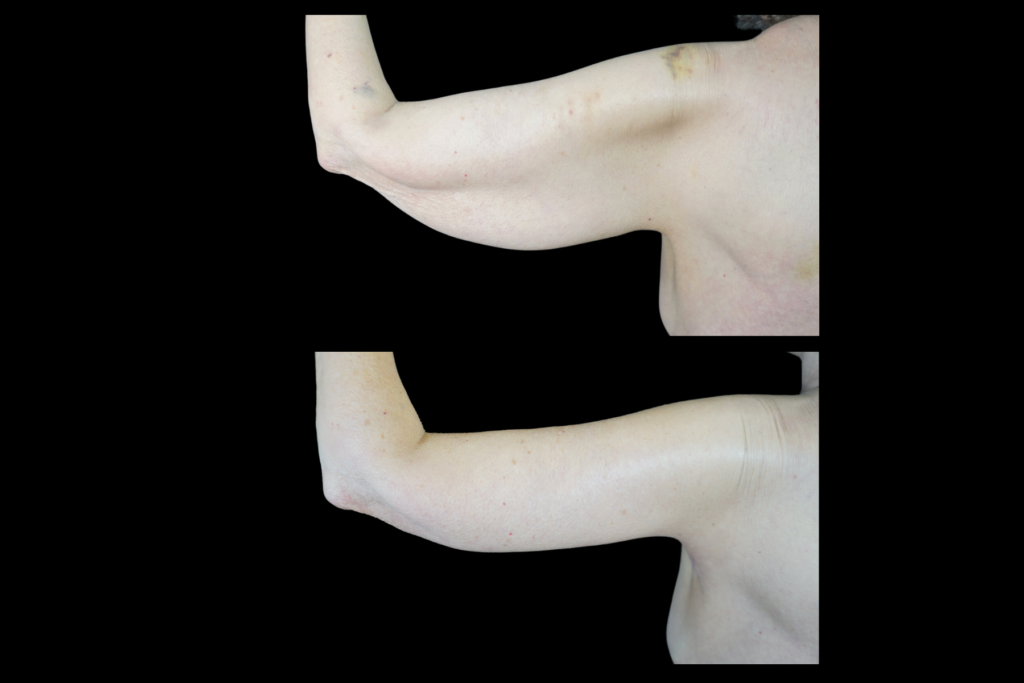 Brachioplasty Before and After Denver
