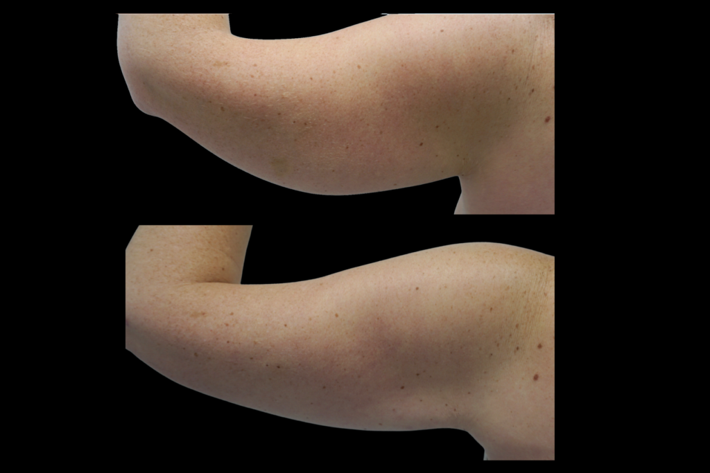Mini Arm Lift Before and After Side View